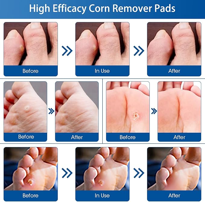 24 Count Corn Removal Pads for Feet and Toe, Corn Feet Remover for Feet Extra - Image 5